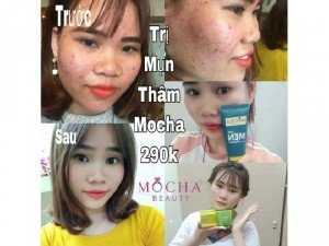 Trị mụn đông y