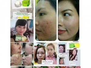 Trị mụn đông y