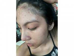 Sản phẩm trị mụn Thanh Trang