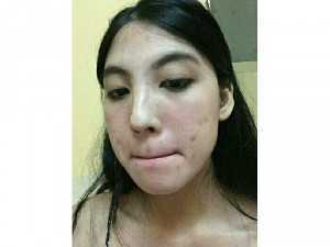 Sản phẩm trị mụn Thanh Trang