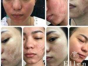 Bạn băn khoăn có nên đi spa trị mụn không? - Trị mụn ở spa có hiệu quả không? Hãy để Ellen Spa làm người giải đáp thắc mắc này cho bạn với dịch vụ lấy mụn ở spa, spa nặn mụn tốt tại Hóc Môn nói riêng cũng như các quận huyện lân cận