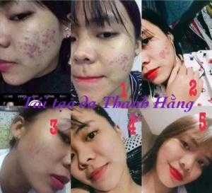 Sản Phẩm Trị Mụn - Tái Tạo Da