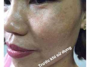 Bộ trị nám da oriflame