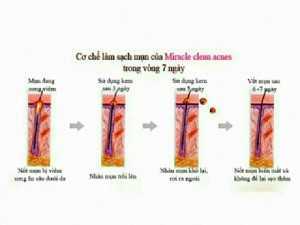 sản phẩm trị mụn