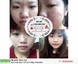 Kem Thảo Dược Tái Tạo Trị Mụn,Thâm,Nám