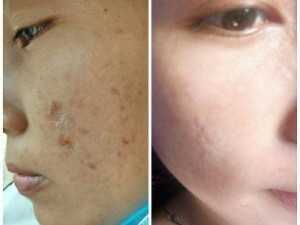 Bộ kit trị mụn và thâm, se khít lỗ chân lông