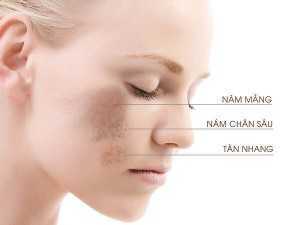 Kem Đặt Trị Nám White Lab Dasoni Cream