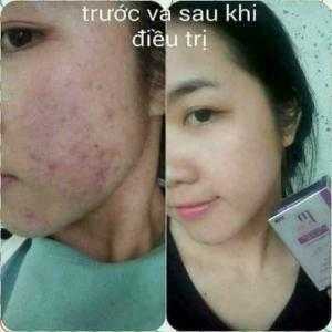 Bộ trị mụn tối ưu Mwhite
