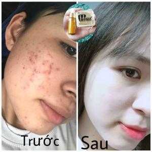 Bộ trị mụn tối ưu Mwhite