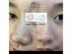 Tinh chất ủ mụn OHIO Hàn Quốc