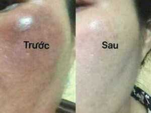 Face tri nam