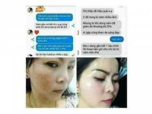 Bộ trị nám ,tàn nhang của Mp MoCha