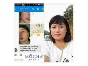 Bộ trị nám ,tàn nhang của Mp MoCha