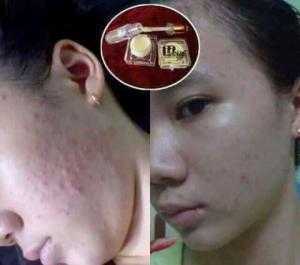 Kem trị mụn Mwhite