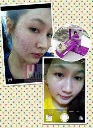Kem trị mụn Mwhite