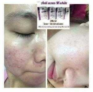 Kem trị mụn Mwhite