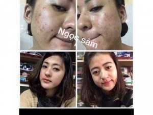 Trị mụn ngọc sâm