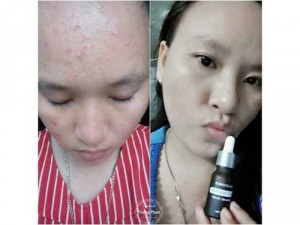 Serum Mụn _ Liala D’Amour