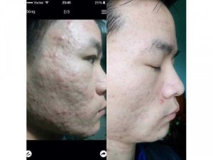 Tinh chất serum trị mụn