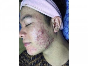 Tinh chất serum trị mụn