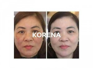 Kem trị nám da korena Hàn Quốc