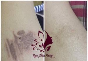 Tinh dầu trị thâm Ngọc Thiên Hương