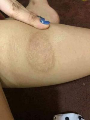 thâm do bỏng bô, bỏng dầu ăn, nước sôi