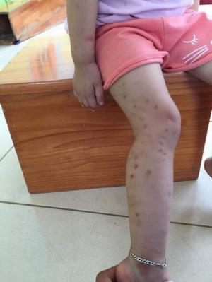 thâm do muỗi côn trùng cắn