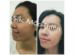 Trị mụn , nám 1 cách hiệu quả nhất.