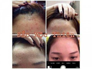 Trị mụn hiệu quả