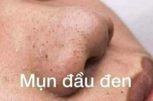 Kem mụn hiệu quả
