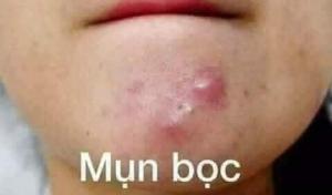 Kem mụn hiệu quả