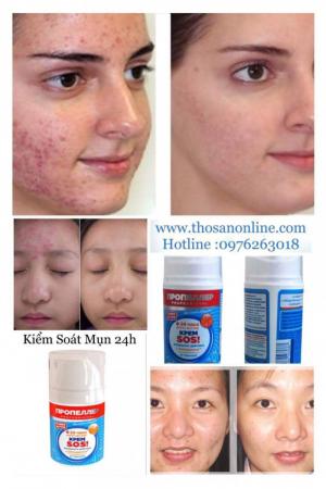 Kem Trị Mụn SOS Turbo Active Nga