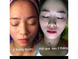 Bộ trị mụn lamer care