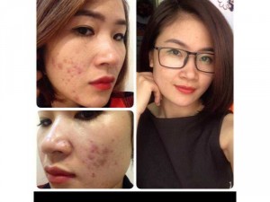 Bộ trị mụn lamer care