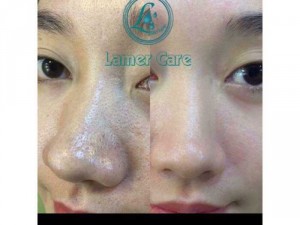 Ủ mụn đầu đen lamer care