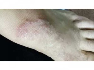 Chàm 10 năm đã khỏi hoàn toàn với 5 lọ kem bé nhỏ đáng iu