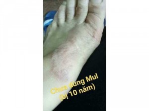 Chàm 10 năm đã khỏi hoàn toàn với 5 lọ kem bé nhỏ đáng iu