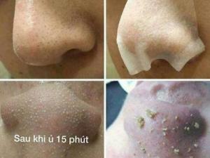 Doctor Li Trị Mụn Số 1 Sạch Bay Mụn Cám, Mụn Đầu Đen Sau 15P Ủ