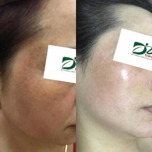 Hoàng Ngưu Tất - Bộ sản phẩm trị nám nặng - 0356781785