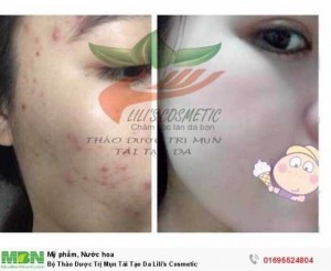 Bộ Thảo Dược Trị Mụn Tái Tạo Da Lili’s Cosmetic