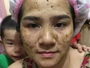 Sắc mộc lam chuyên hỗ trợ người bị nám t