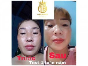 Nữ Hoàng Trị Nám, Tàn Nhang