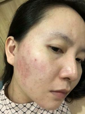 Serium Trị Mụn Nám Essence Peptide