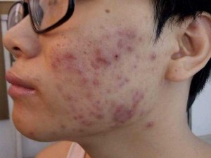 Bộ trị mụn đông y