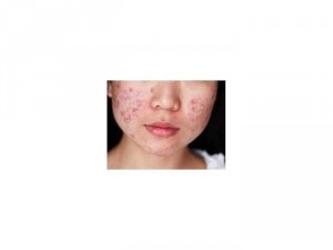 Bộ trị mụn đông y