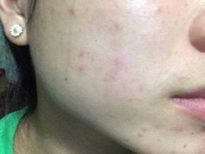 Bộ trị mụn đông y