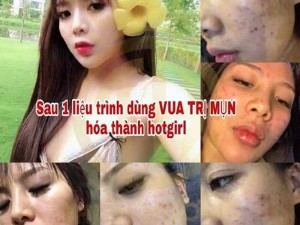 Tinh chất đặc trị mụn đông y