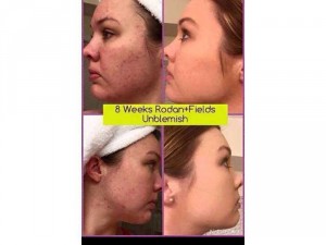 Cần Thanh lý bộ MP UNBLEMISH Đặc trị cho da mụn