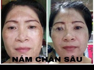 Serum đặc trị nám